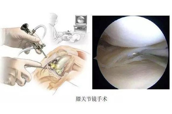膝关节老年性骨关节炎的“金字塔”治疗模式