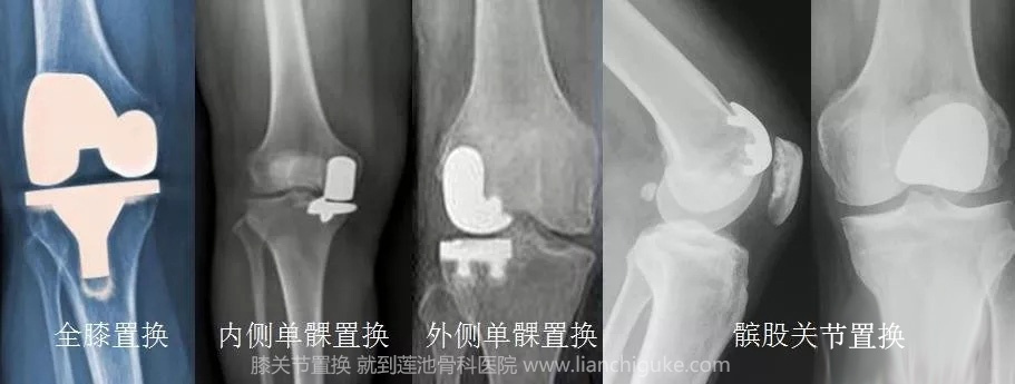 膝关节置换手术流程