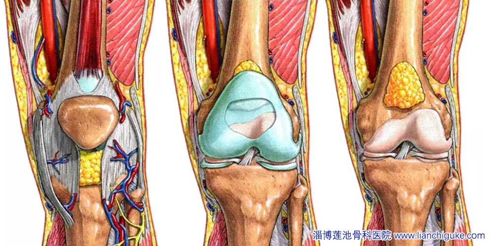 膝关节骨性关节炎的图示